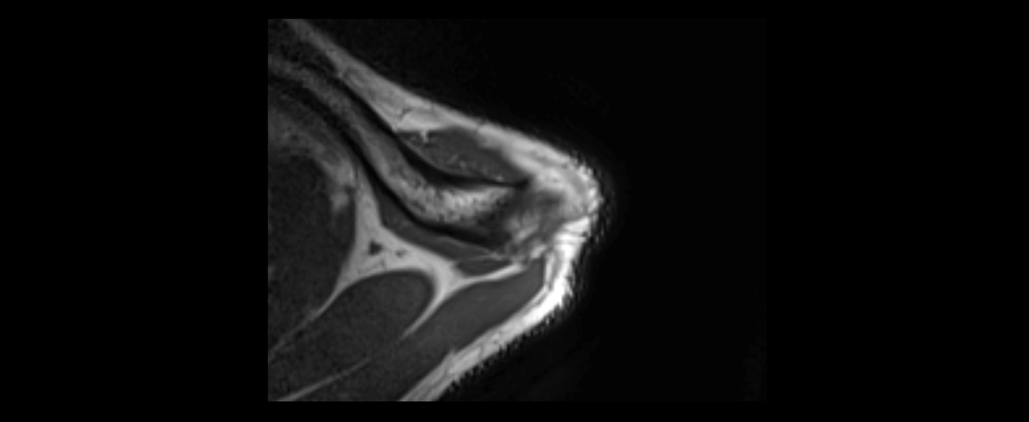 shoulder ligaments axial 3d 3t mri image-img-00005-00015.webp